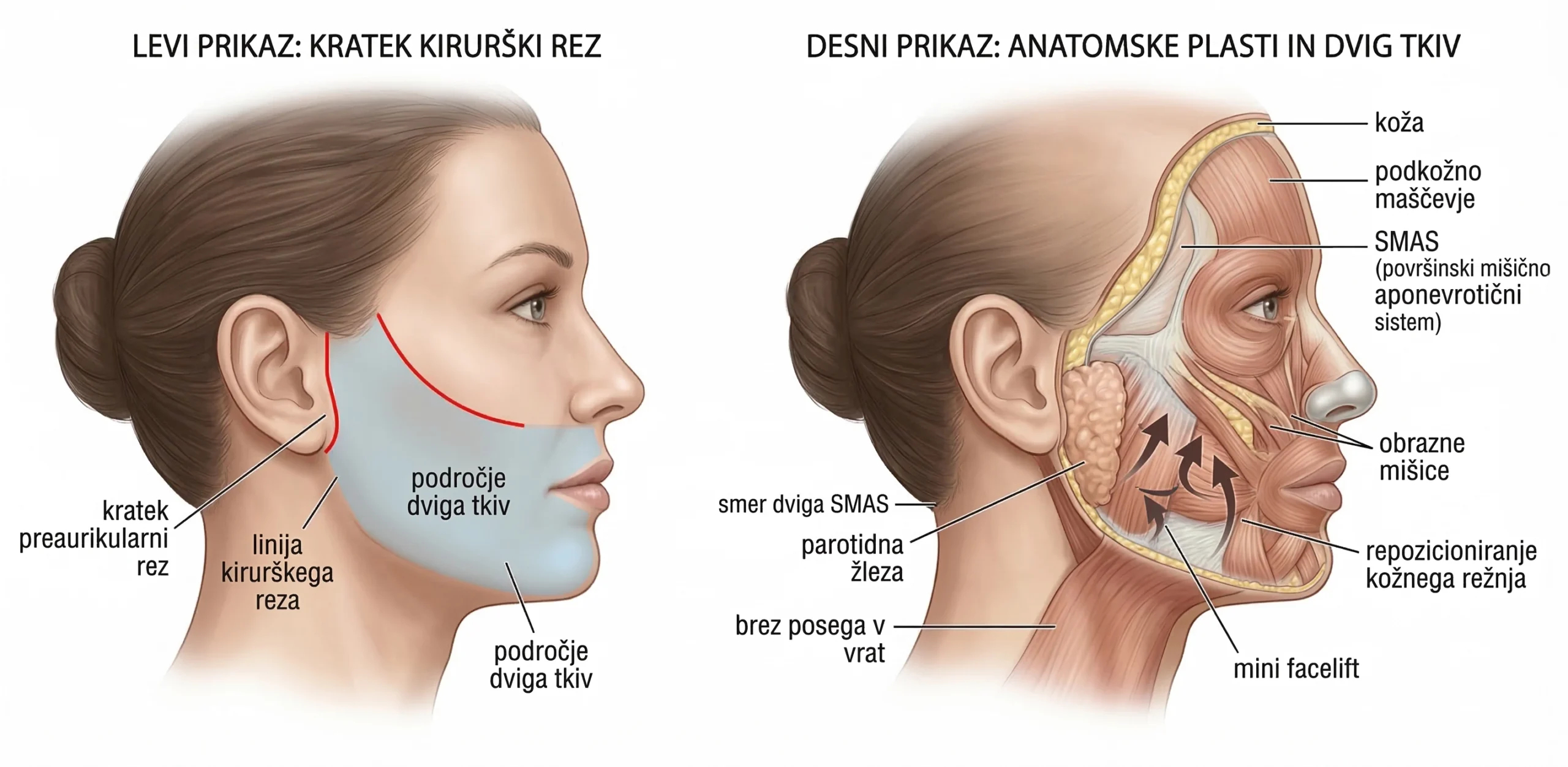 Shema mini facelifta (short scar facelift), pri katerem krajši kirurški rez pred ušesom omogoča dvig tkiv spodnje tretjine obraza z manj invazivnim pristopom.