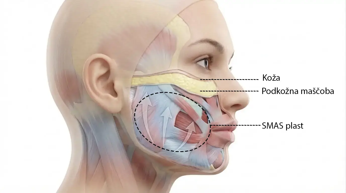 Anatomski prikaz SMAS plasti obraza z vektorji dviga za kirurški lifting obraza
