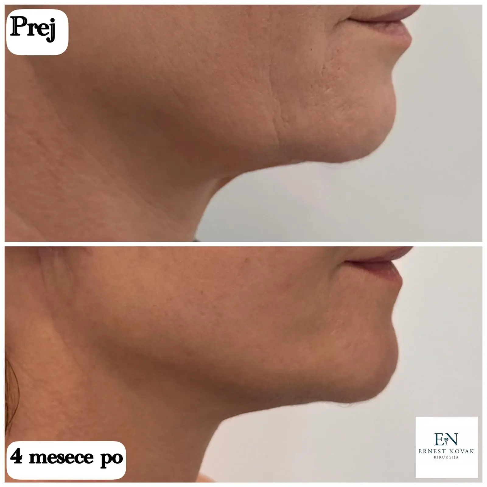 Rezultat pomladitve čeljustne linije in vratu 4 mesece po faceliftu