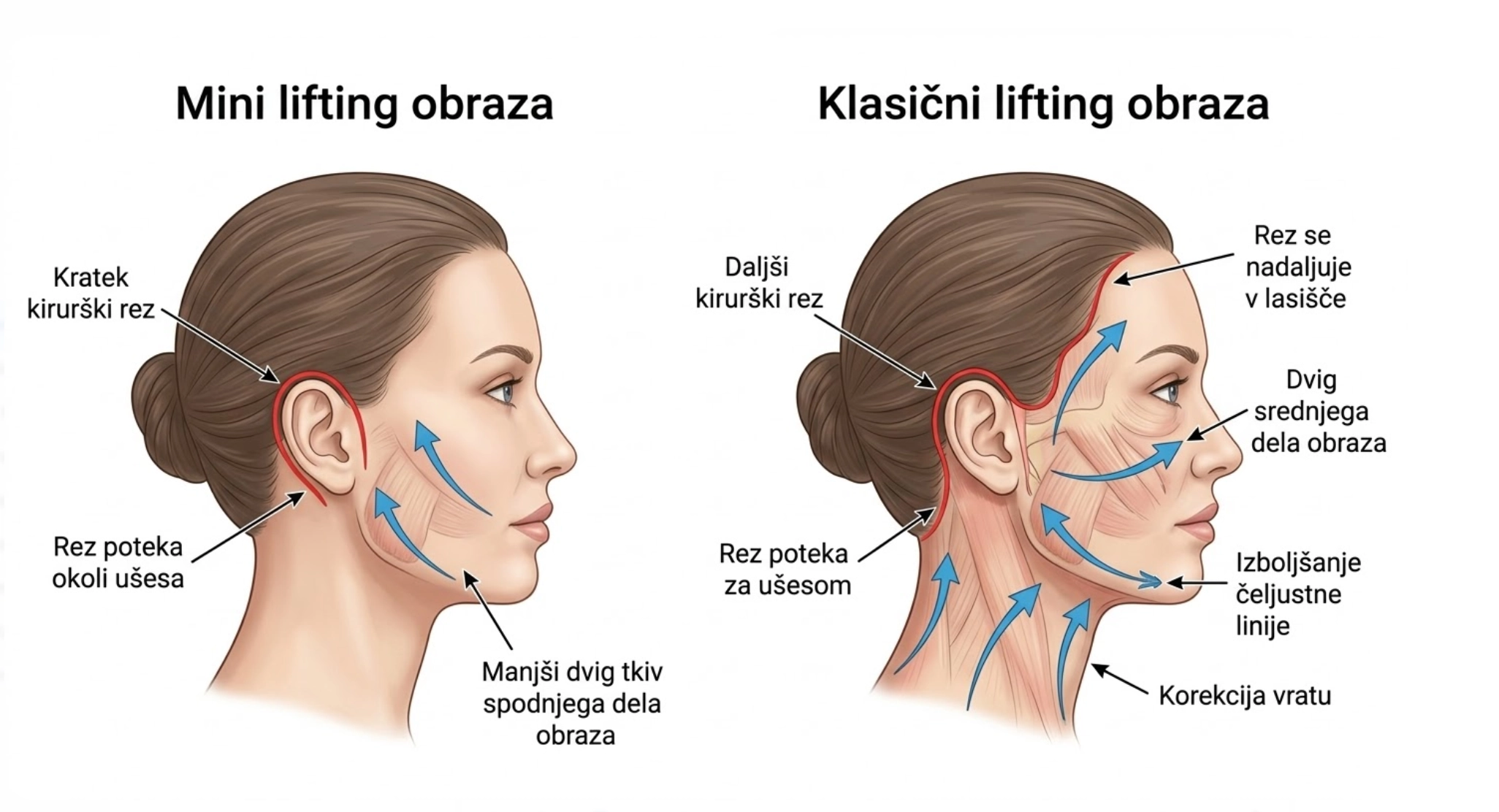 primerjava rezov mini lifting obraza in klasični lifting obraza