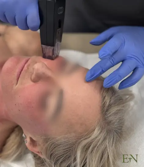 Radiofrekvenčni microneedling spodbuja tvorbo kolagena in zateguje kožo brez kirurškega posega.