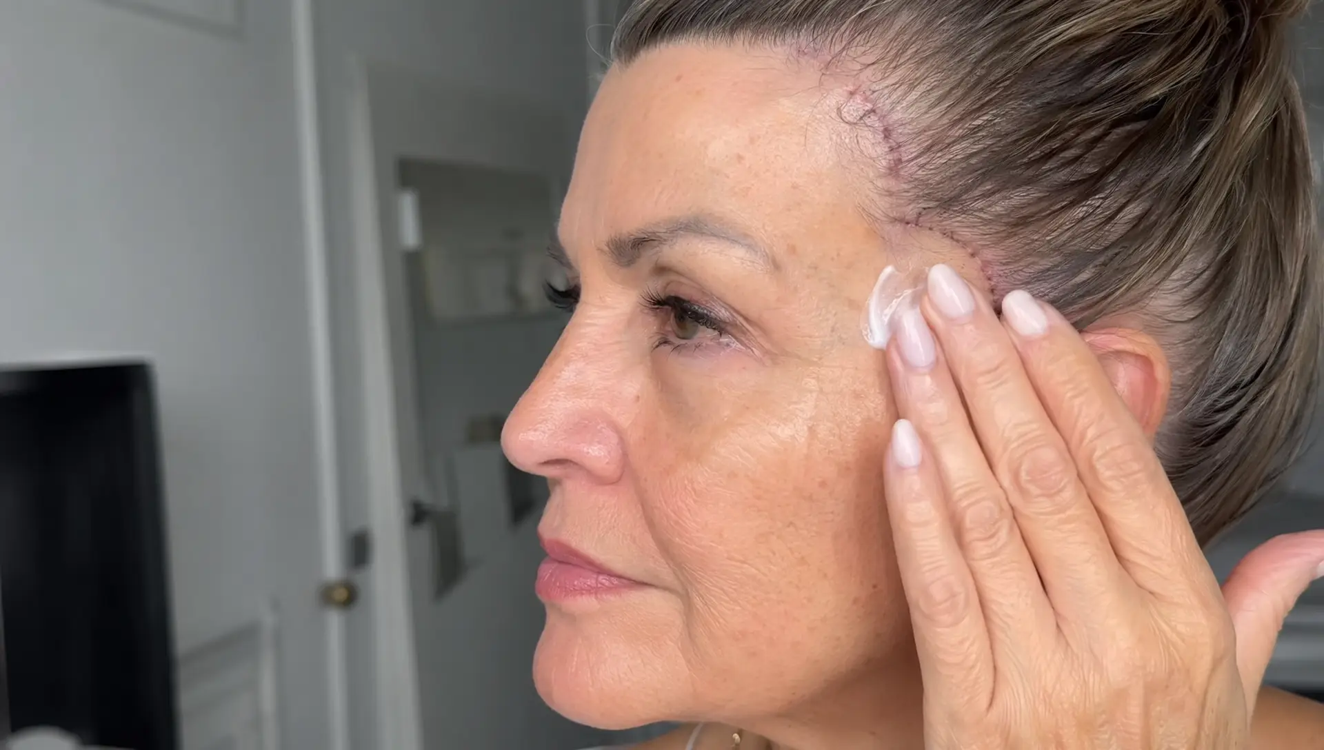 Ženska po faceliftu nanaša kremo na predel ob lasišču, kjer so vidne brazgotine po posegu.