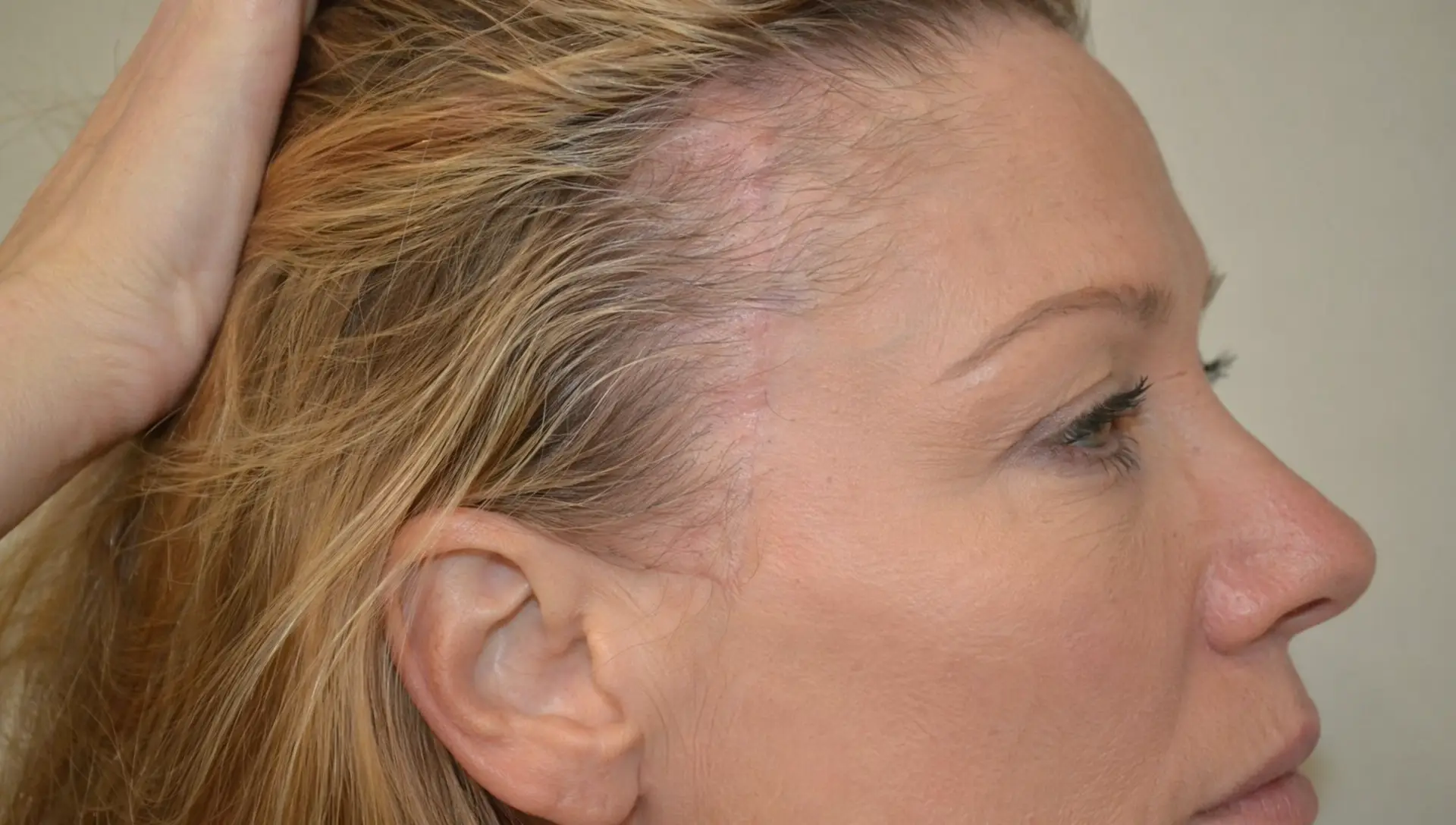 Ženska od strani z odmaknjenimi lasmi, pri kateri so ob lasišču rahlo vidne tanke zaceljene brazgotine po faceliftu.