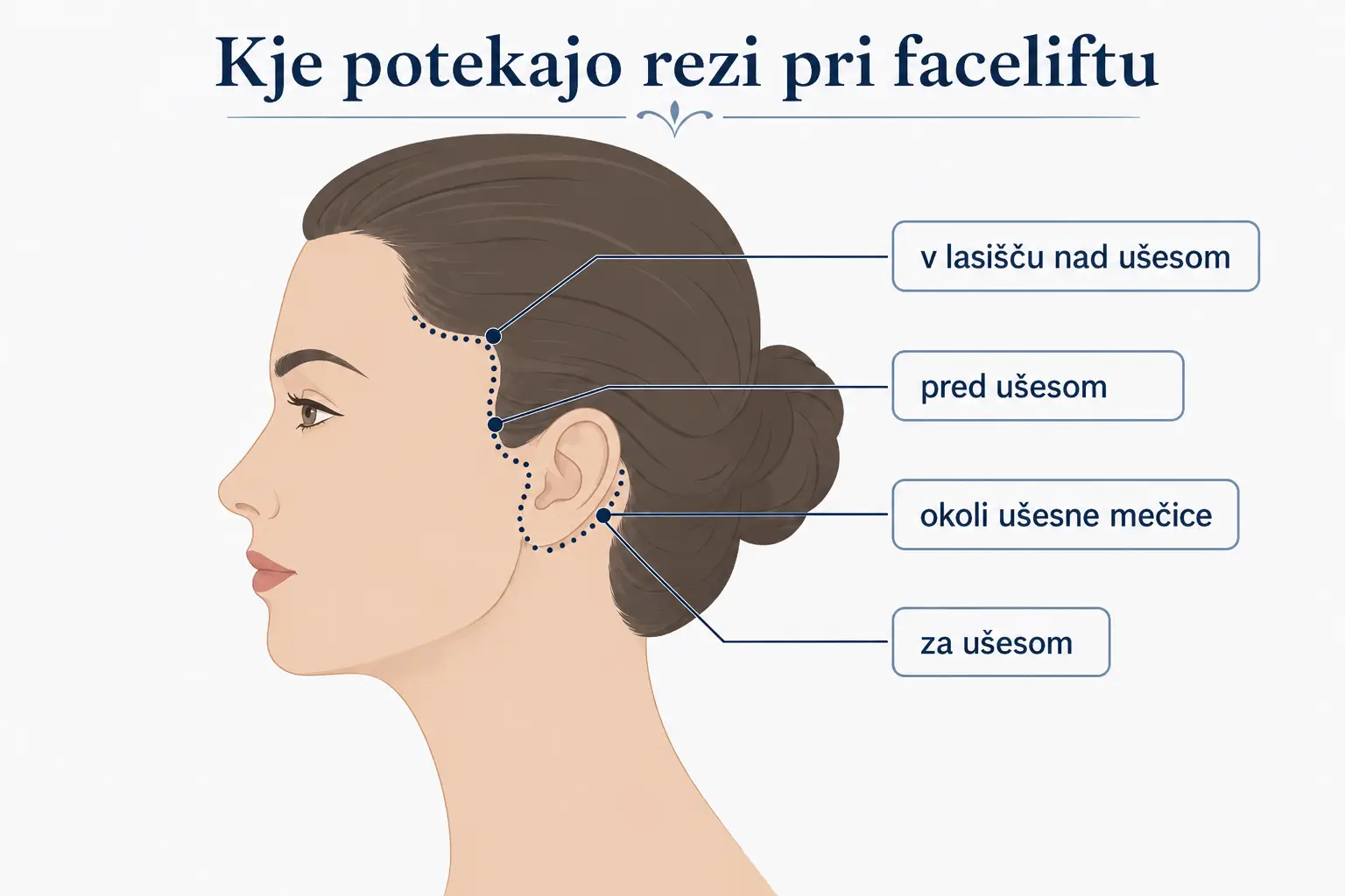 potek rezov pri faceliftu okoli ušesa in v lasišču