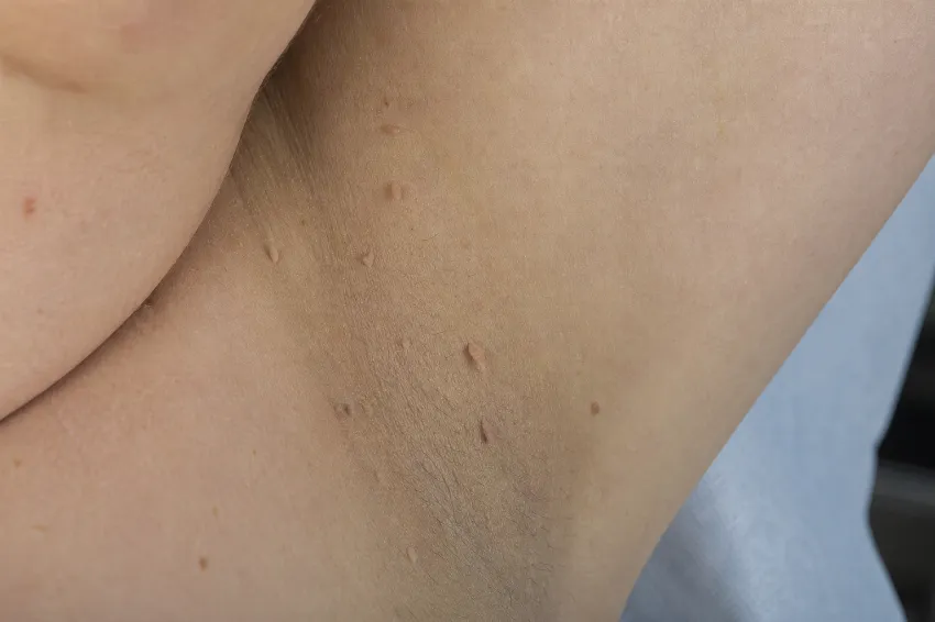 Mehki fibromi na mestih trenja kože, kot so pazduhe