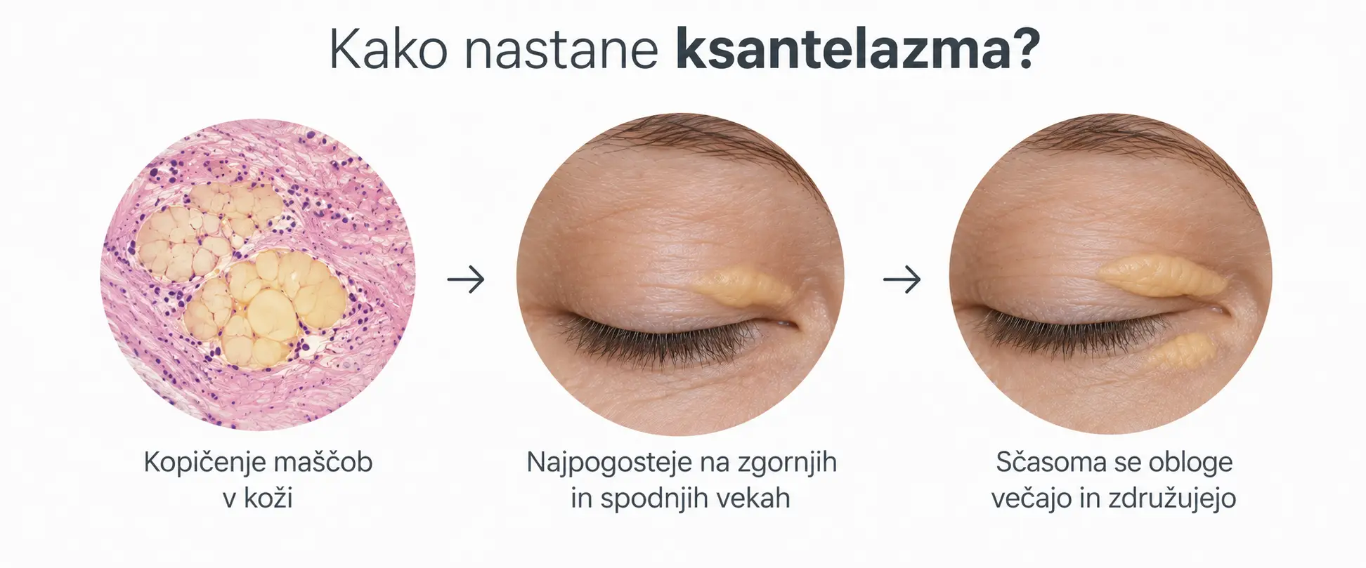 Nastanek ksantelazme zaradi kopičenja z lipidi napolnjenih celic v koži vek