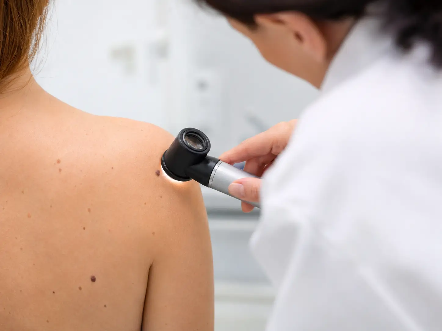 Dermatoskopski pregled kožnega znamenja na hrbtu pacientke